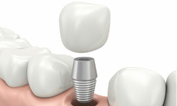 Image Text: dental_implants_1