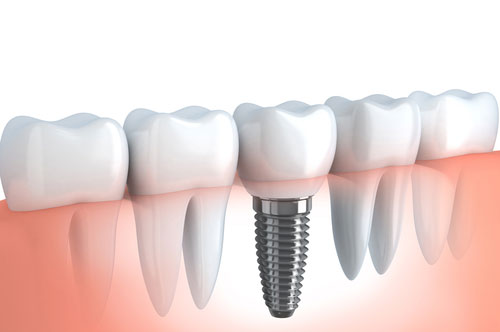 Image Text: dental_implants_2